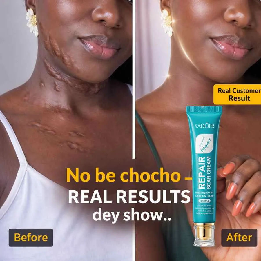 Keloid scarring   neck and chest
