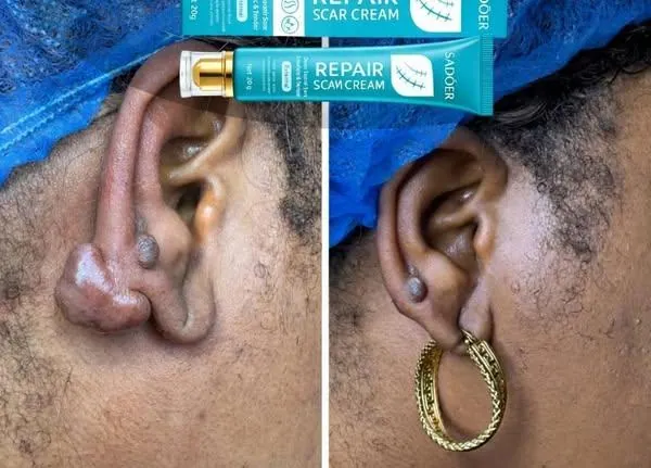 Keloid   ear