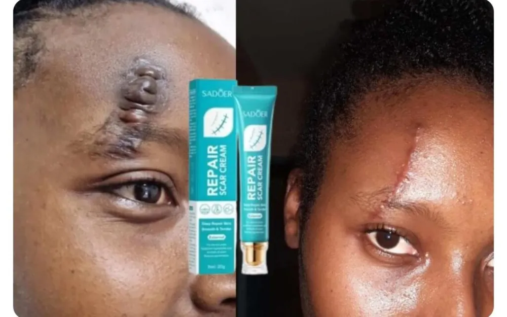 Surgical scar   forehead