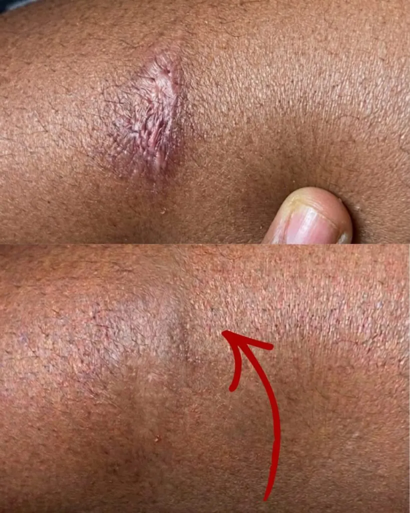 Scar   healing progress