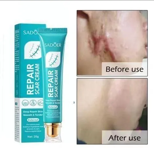 Scar before and after using SADOER
