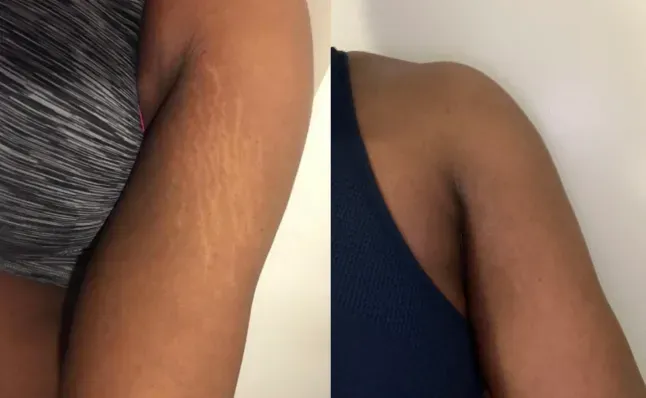 Stretch marks   arm