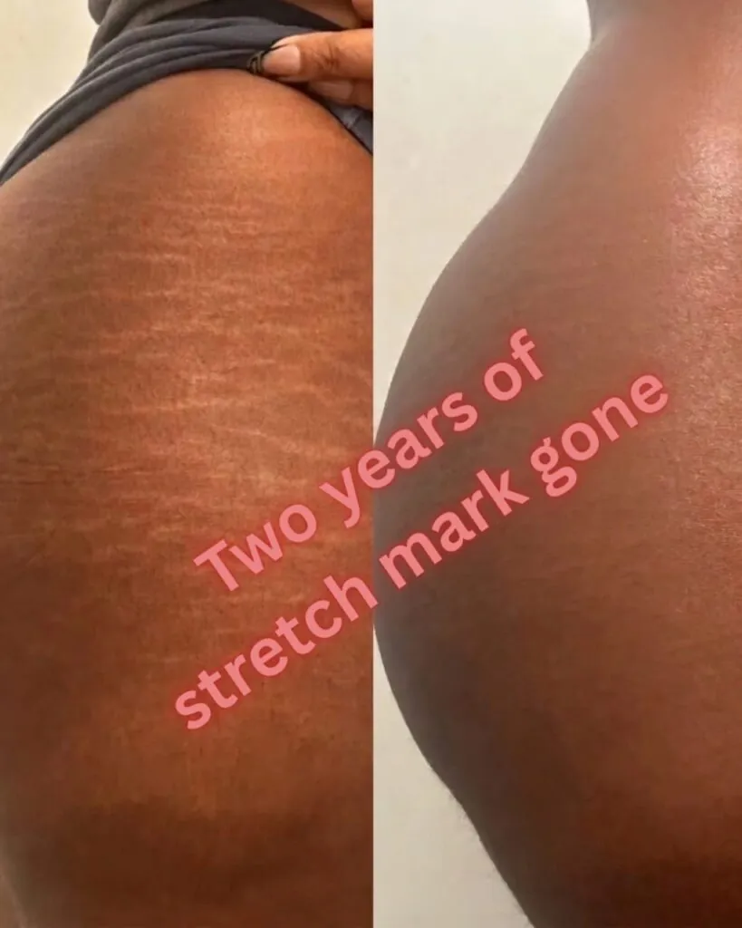 Stretch marks   two years faded