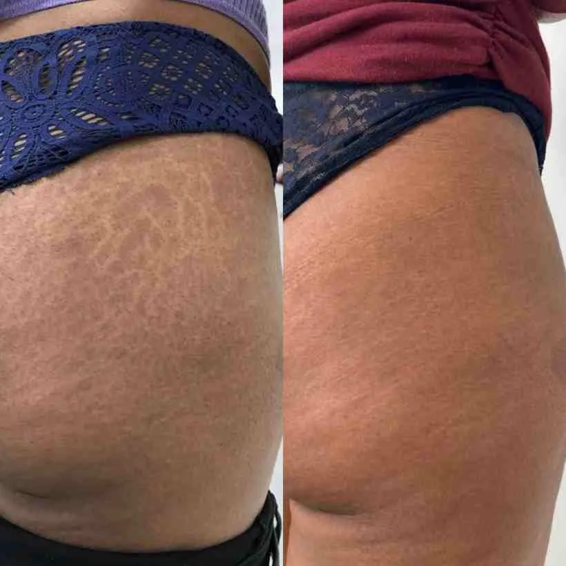 Stretch marks   hip