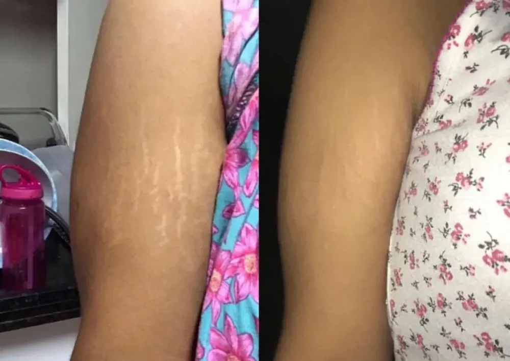 Stretch marks   faded