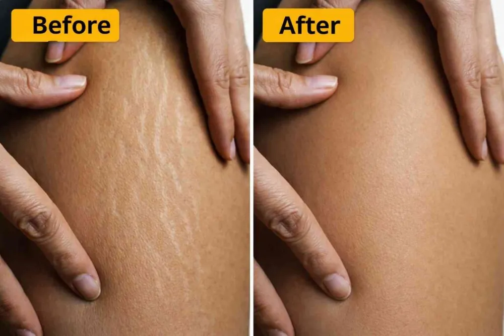 Stretch marks   thigh